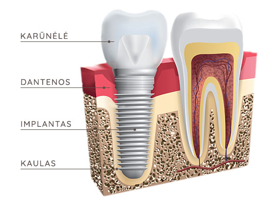 Isolate Contraction optional Dantų implantavimas | Kokybiški implantai | Nemokama konsultacija