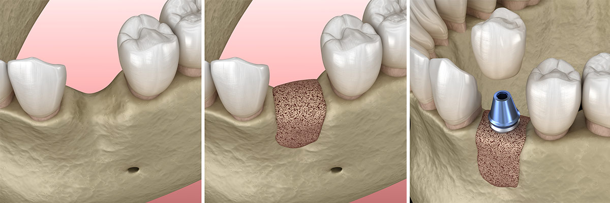 Isolate Contraction optional Dantų implantavimas | Kokybiški implantai | Nemokama konsultacija