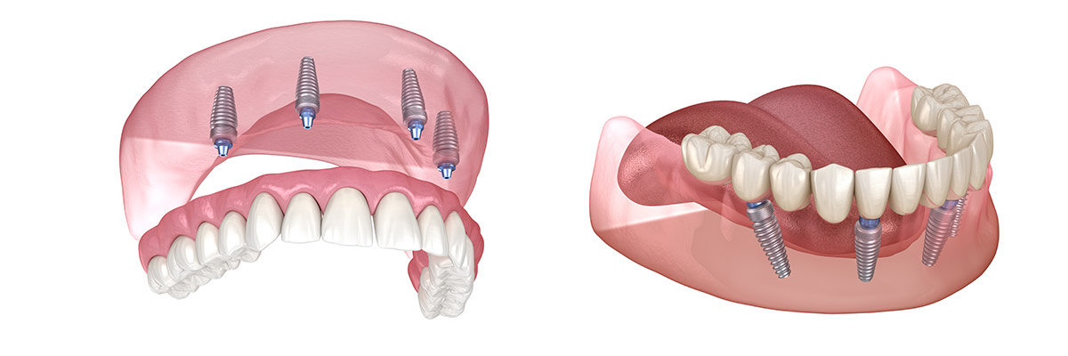 Dantų-implantacija-all-on-4